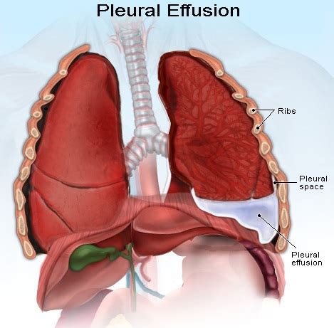 Pleural effusion - Causes, Types, Symptoms, Diagnosis and Treatment