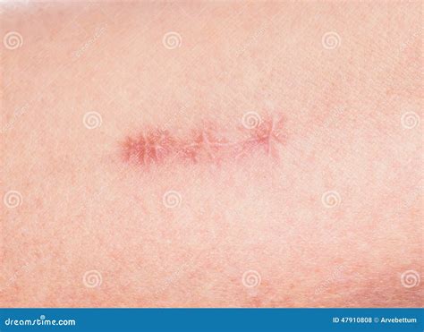 Redness Around Healing Stitches on Skin Stock Photo - Image of damage ...