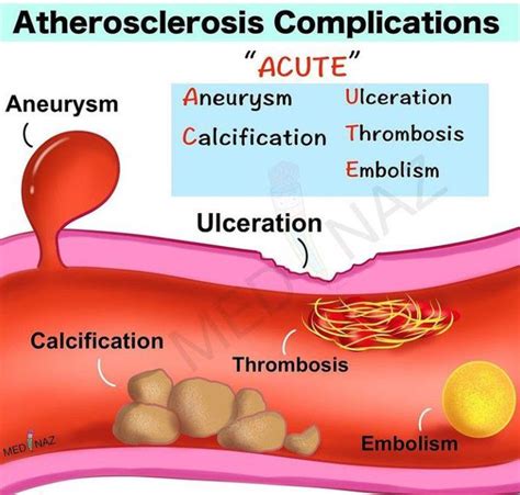 Atherosclerosis complications - MEDizzy