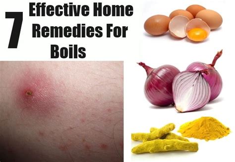 7 Effective Home Remedies For Boils | Home remedy for boils, Natural remedies for boils, Home ...