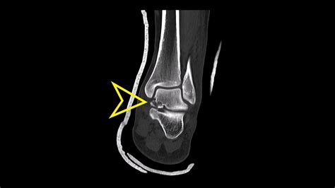 Ankle CT: Talus Neck Fracture - YouTube