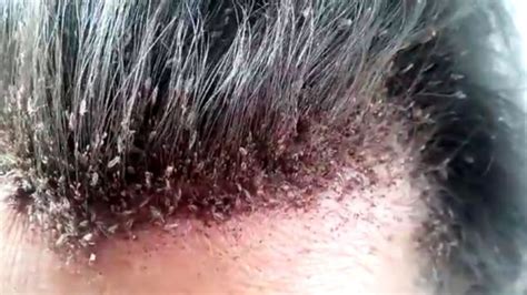 Head Lice Infestation - Symptoms, Causes And Risk Factors