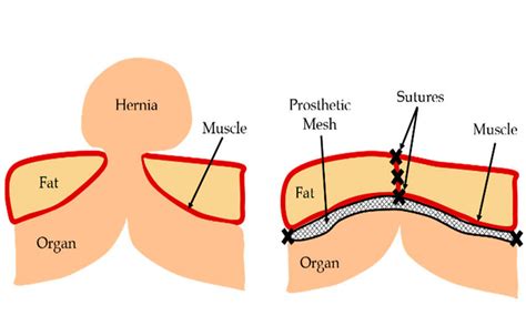 Prosthetic mesh not recommended for prevention of parastomal hernia ...