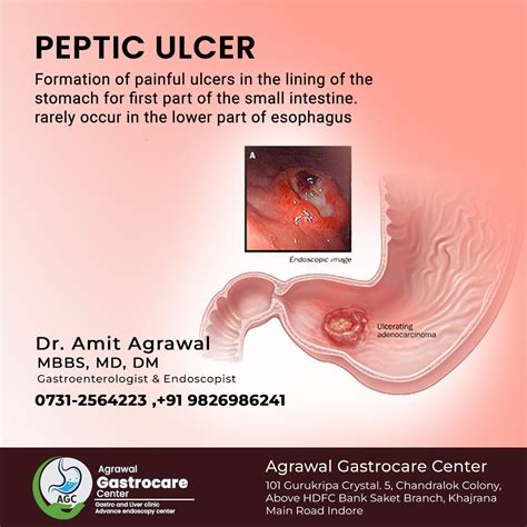 What is Peptic Ulcer, Treatment - Agrawal Gastrocare Center Indore