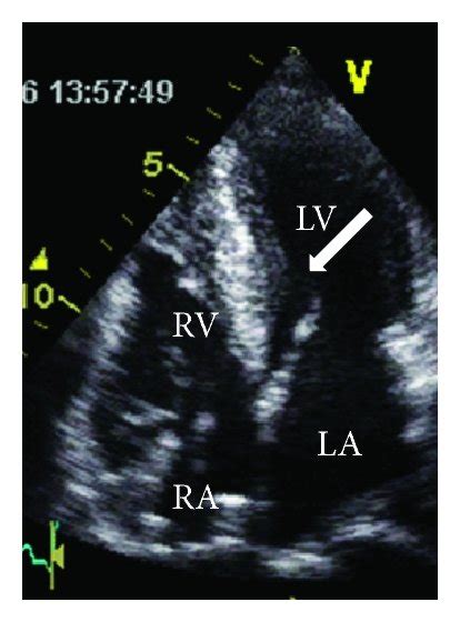 Echocardiographic aspect of HOCM before/after a myectomy ((a)–(d)) and ...