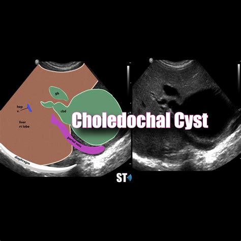 Choledochal Cyst – Sonographic Tendencies