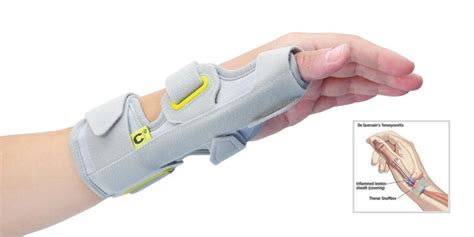 Wrist Splint For De Quervain's Tenosynovitis Compare Prices | dev-techtatva.manipal.edu