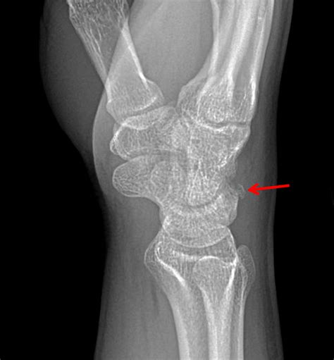 Triquetral Fracture Radiology