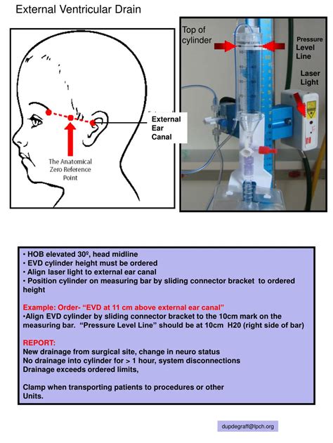 PPT - External Ventricular Drain PowerPoint Presentation - ID:211079