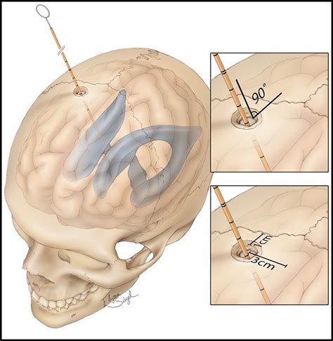 Standard procedure of external ventricular drain (EVD) placement ...