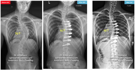 Before and After Scoliosis Surgery with Darryl Antonacci