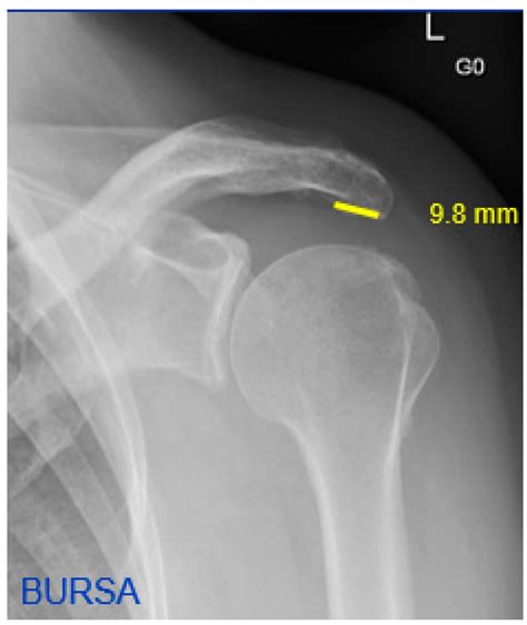 JCM | Free Full-Text | Acromial Morphology and Its Relation to the Glenoid Is Associated with ...