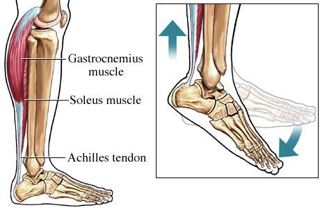 Midpoint Achilles Tendonitis