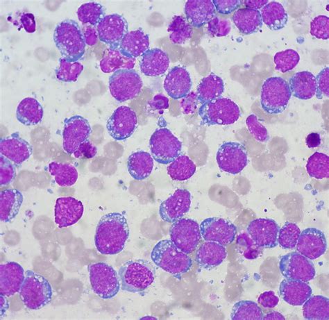 Burkitt Lymphoma (FNA, Giemsa stain) | On immunophenotyping … | Flickr