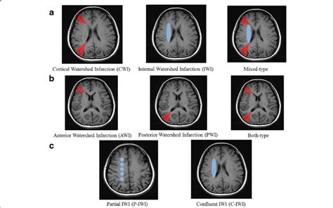 Classification of watershed infarction (WSI): (a) types of WSI; (b)... | Download Scientific Diagram