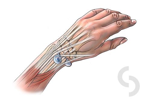 Wrist Ganglion | dr Sonja Cerovac