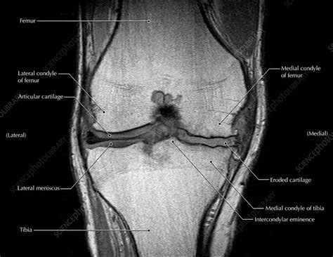 Knee Arthritis, MRI - Stock Image - C027/1212 - Science Photo Library