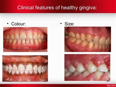 Gingiva in health and disease