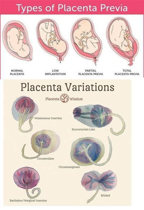 Placenta variations and what they look like | Nursing school notes, Nursing school studying ...