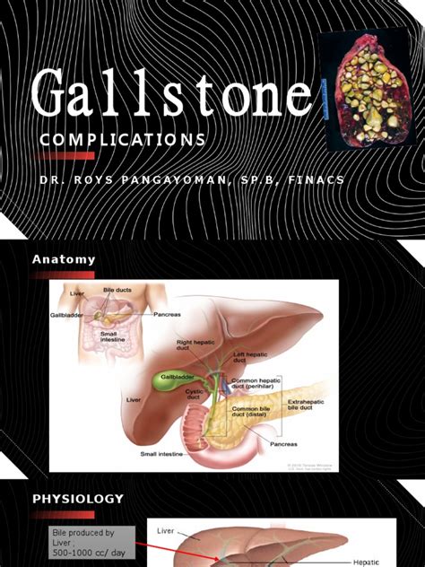 Gallstone Complications | Download Free PDF | Gallbladder | Gastroenterology