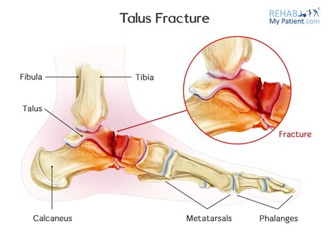 Talus Fracture | Rehab My Patient