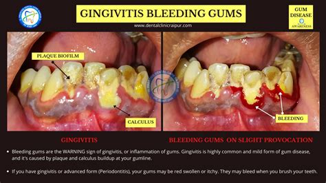 Periodontitis & Gingivitis Meaning Symptoms Tx | Gum Disease