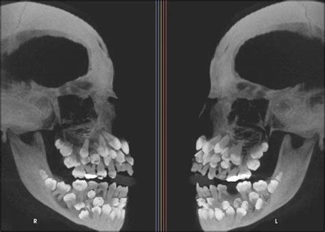 An X-ray of a person with Multiple Hyperdontia. : r/WTF