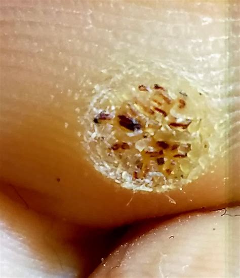 Plantar wart Archives • PAULx