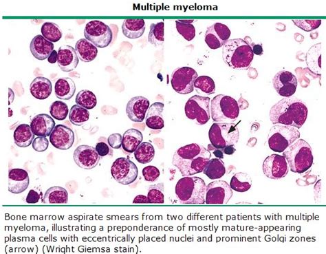 Bone marrow biopsy results in multiple myeloma