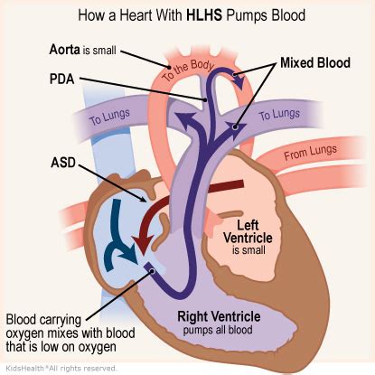 Hypoplastic Left Heart Syndrome (HLHS) (for Parents) - Humana - Louisiana