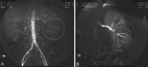 Figure 0001:Lumbar artery pseudoaneurysm following percutaneous nephrolithotripsy: Treatment by ...