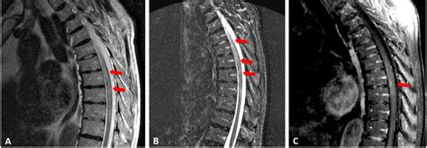 Magnetic resonance imaging showing a longitudinal hyperintense T2... | Download Scientific Diagram