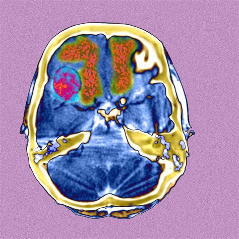 Secondary Brain Cancers, Ct Scan Photograph by Du Cane Medical Imaging ...