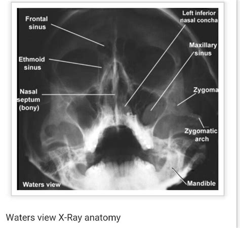 Waters view | Radiology imaging, X ray, Radiology