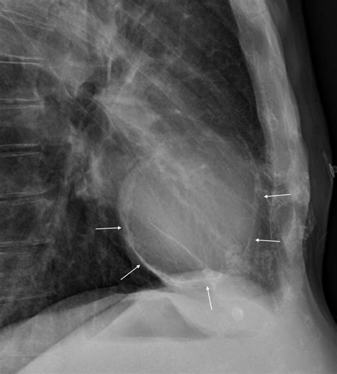 Chest Radiograph Signs Suggestive of Pericardial Disease - American College of Cardiology