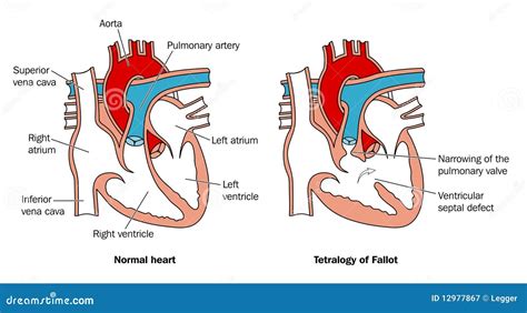 Congenital heart defect stock vector. Illustration of right - 12977867