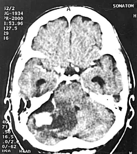 CT scan showing lesion in posterior fossa | Download Scientific Diagram