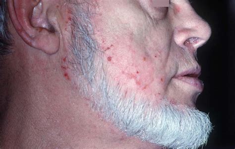 Dermatitis herpetiformis causes, symptoms, diagnosis and treatment