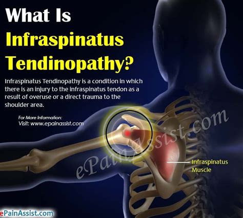 Infraspinatus Tendinopathy | Sports injury, Infraspinatus muscle, Injury