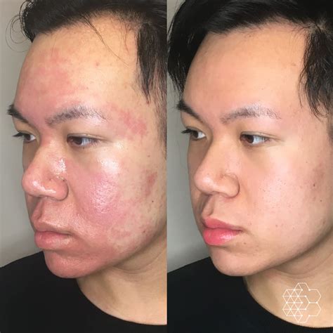 Acne Scar Treatment & Removal Vancouver BC | Skin Technique