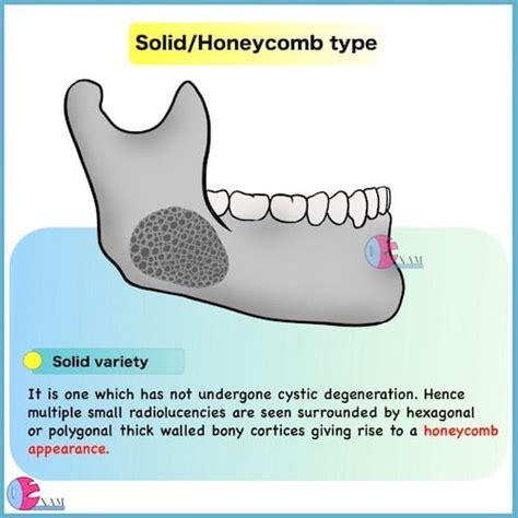 Ameloblastoma Radiology: Dental Radiology Notes