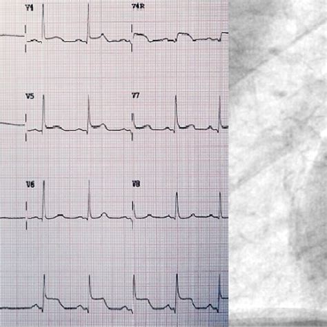 ECG: right coronary artery vasospasm, inferior ST segment elevation ...