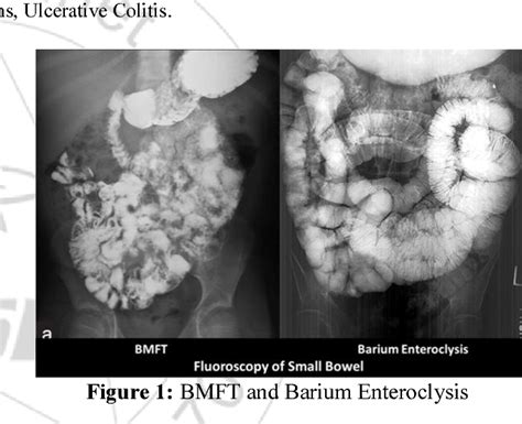 [PDF] Role of CT Enteroclysis in the Evaluation of Small Bowel Pathologies | Semantic Scholar