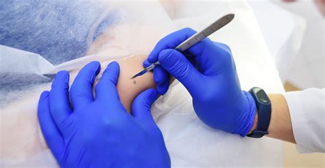 Mole Removal — PC Dermatology - General & Surgical Dermatology in Mooresville, NC