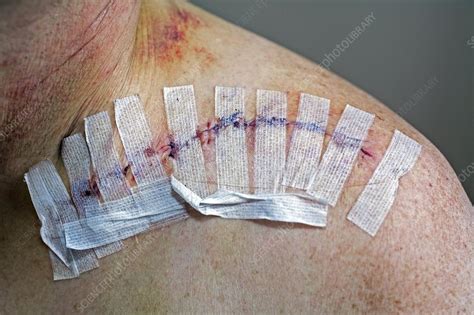 Collar bone surgery - Stock Image - C020/3855 - Science Photo Library