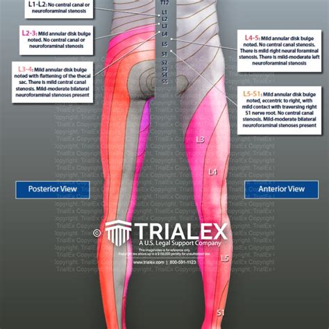 Dermatomes of the Left Leg - TrialExhibits Inc.