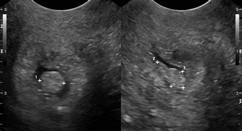 Cervical polyp - wikidoc