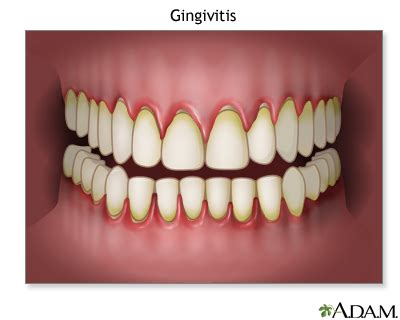Gingivitis Information | Mount Sinai - New York