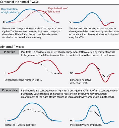 Interpretation of neonatal and pediatric electrocardiograms (ECG) – ECG & ECHO