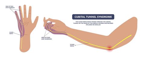 Cubital Tunnel Syndrome - What it is and what you can do about it - Canberra Hand Therapy